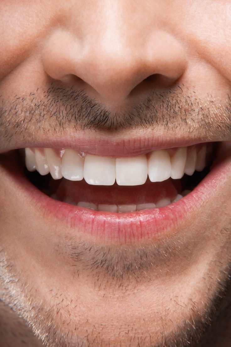 Implantes Dentários